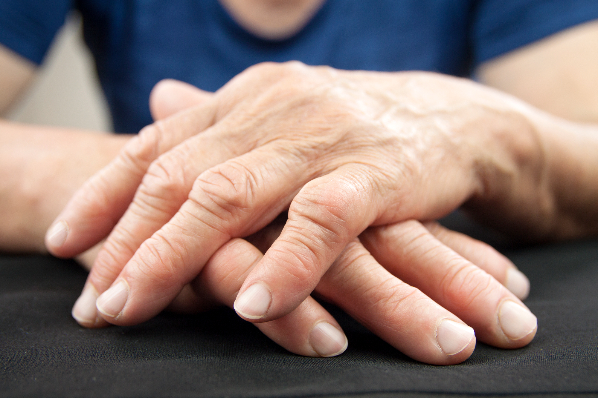 Revmatoidni artritis lahko prizadene vse sklepe ter obsklepne dele